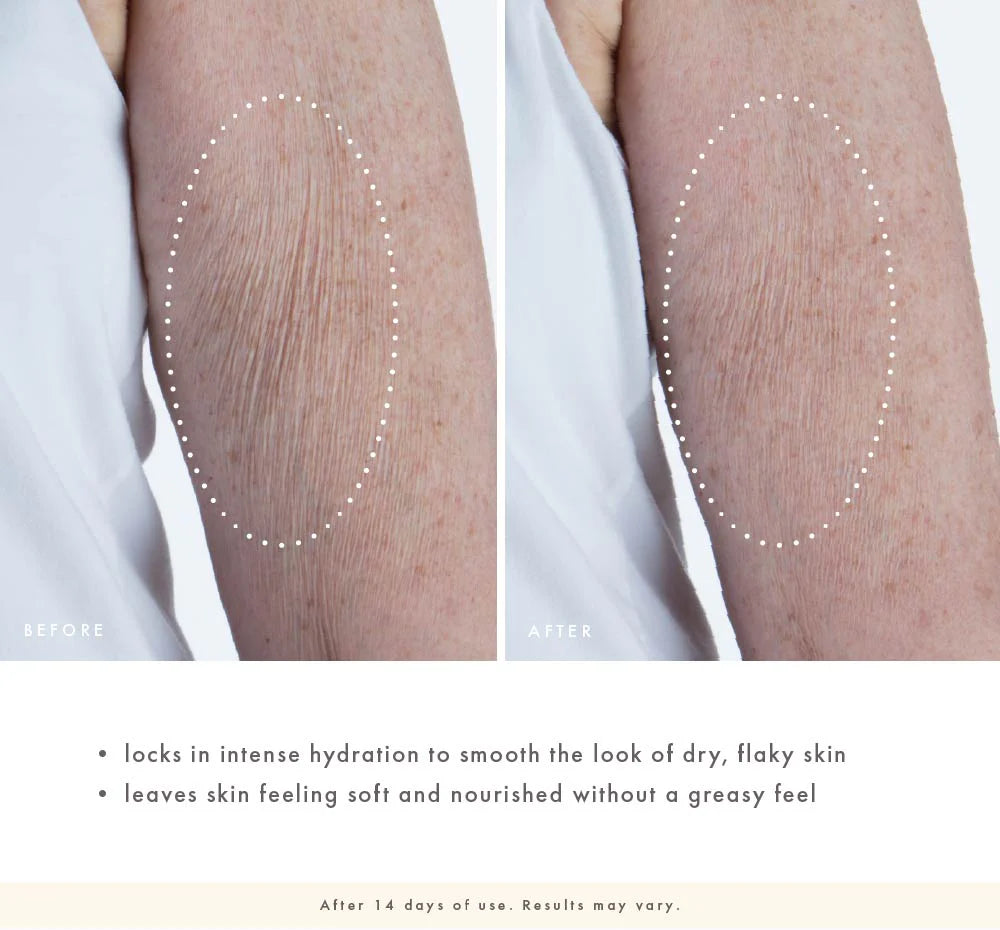 Before and after comparison of dry, flaky skin on a person's arm with text describing product benefits.