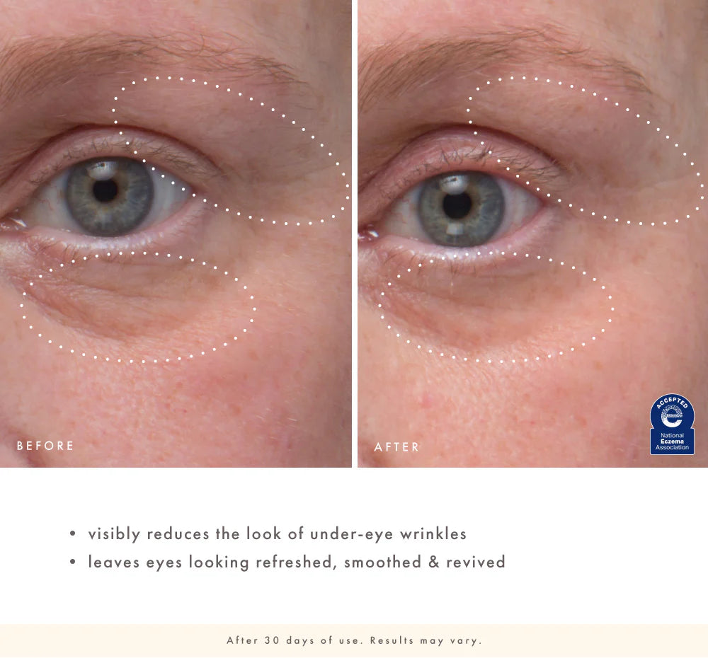 Before and after comparison of under-eye area with visible wrinkle reduction.